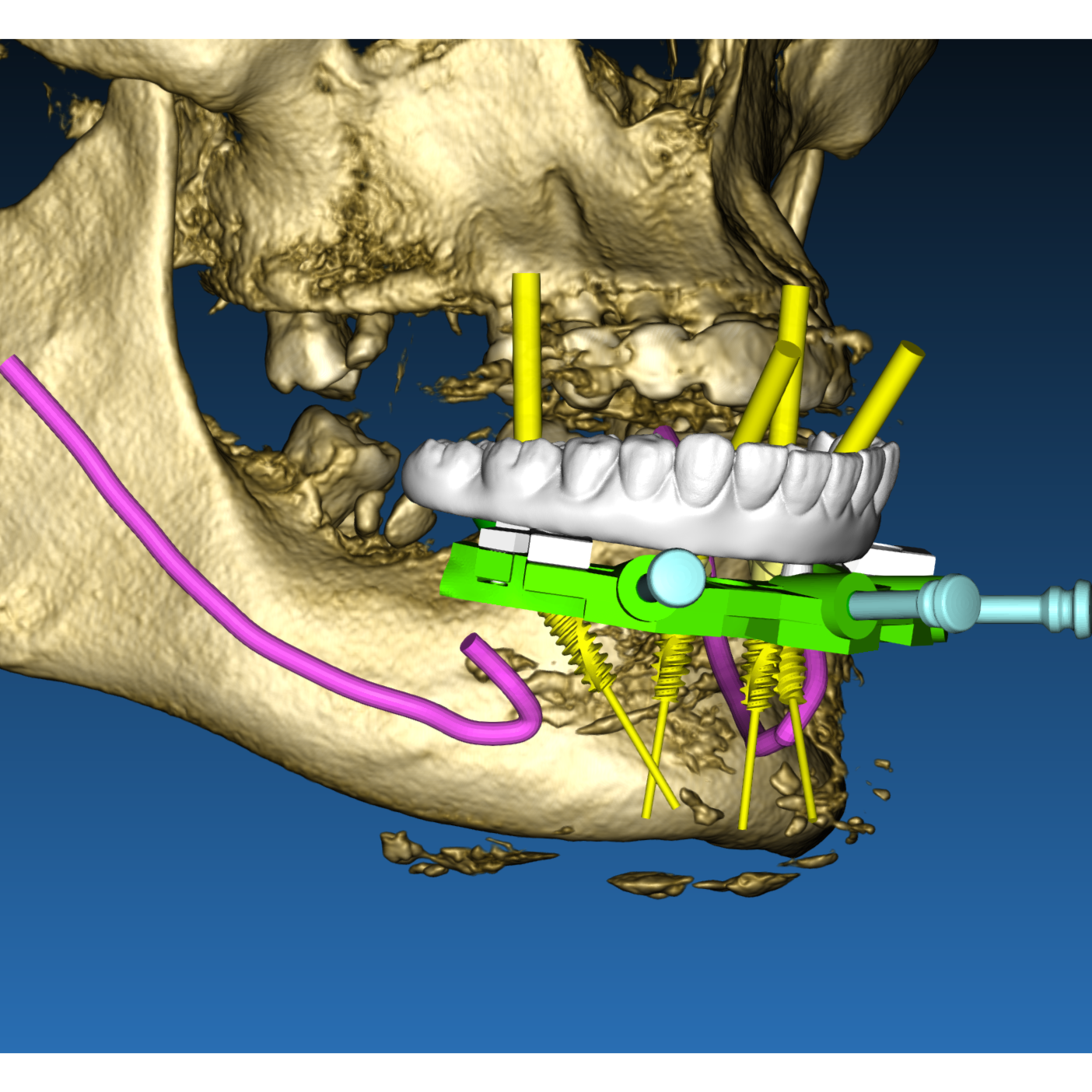 Stackable Surgical Guides