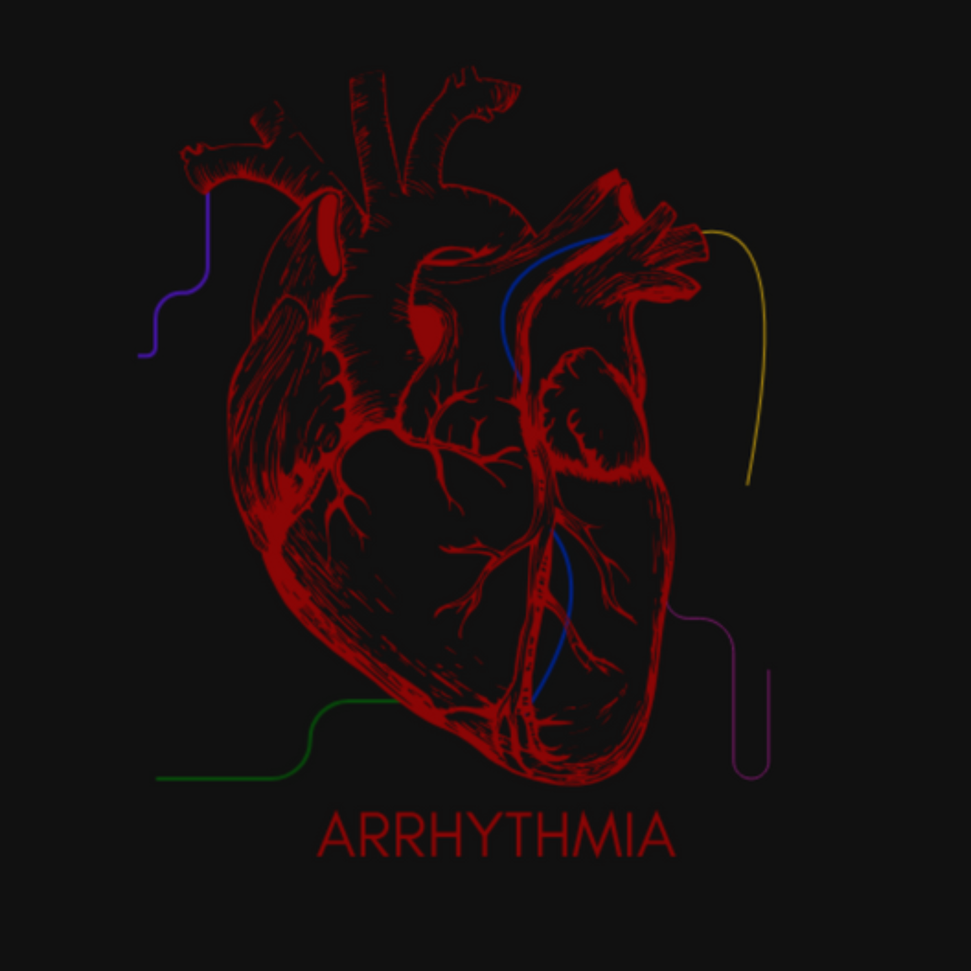 Arrhythmia