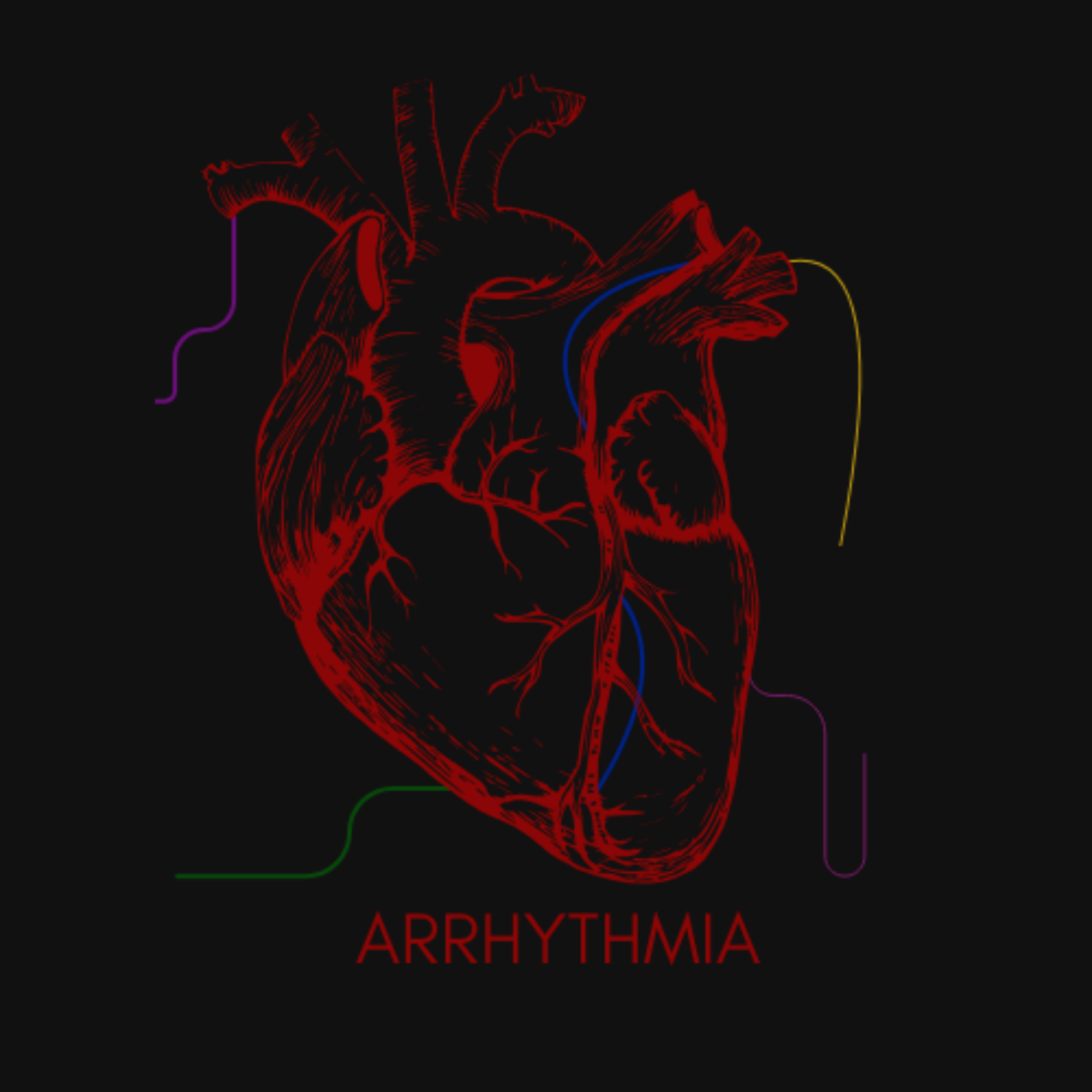 Arrhythmia