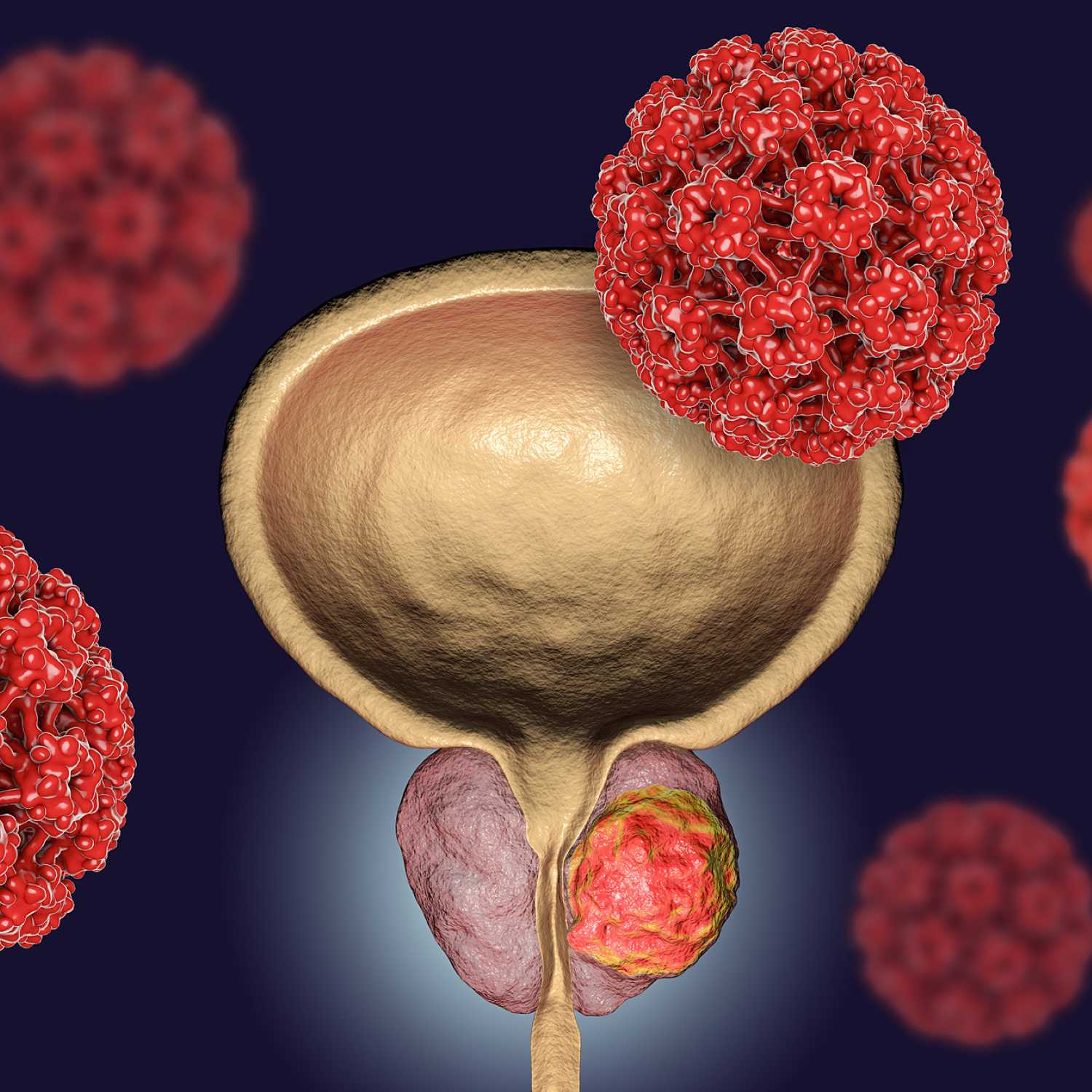 CÁNCER DE PRÓSTATA - BUENVIVIR episode artwork