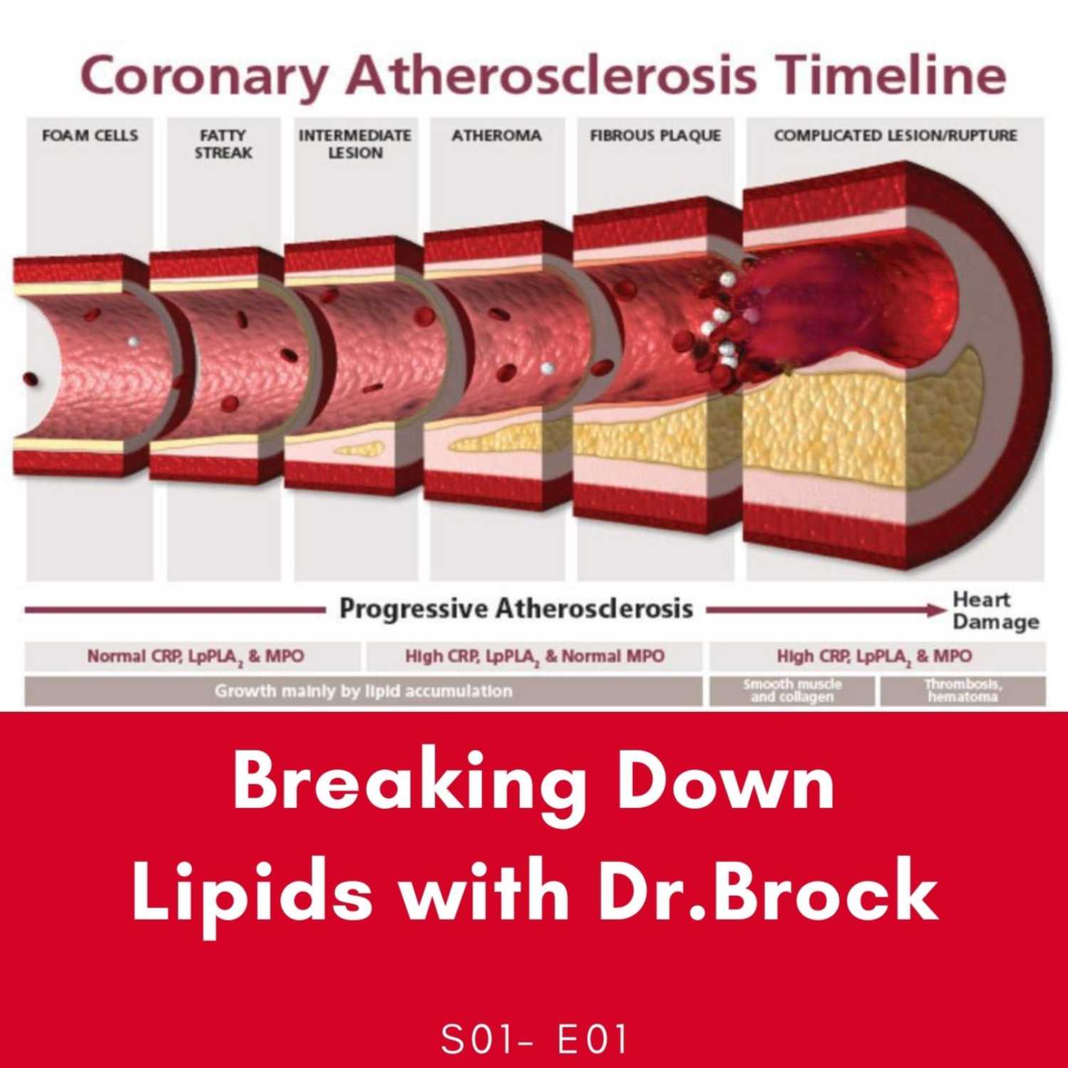 Breaking Down Lipids with Dr.Brock