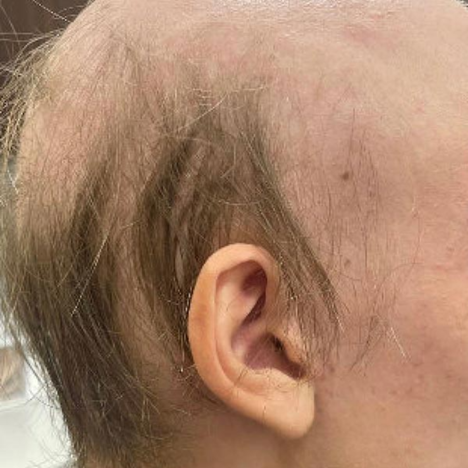 “The MANE Point:  There’s No Such Thing as ‘Mild’ Alopecia Areata” (Don’t Be Rash:  The Pediatric Dermatology Podcast: Y2025, Episode 9)