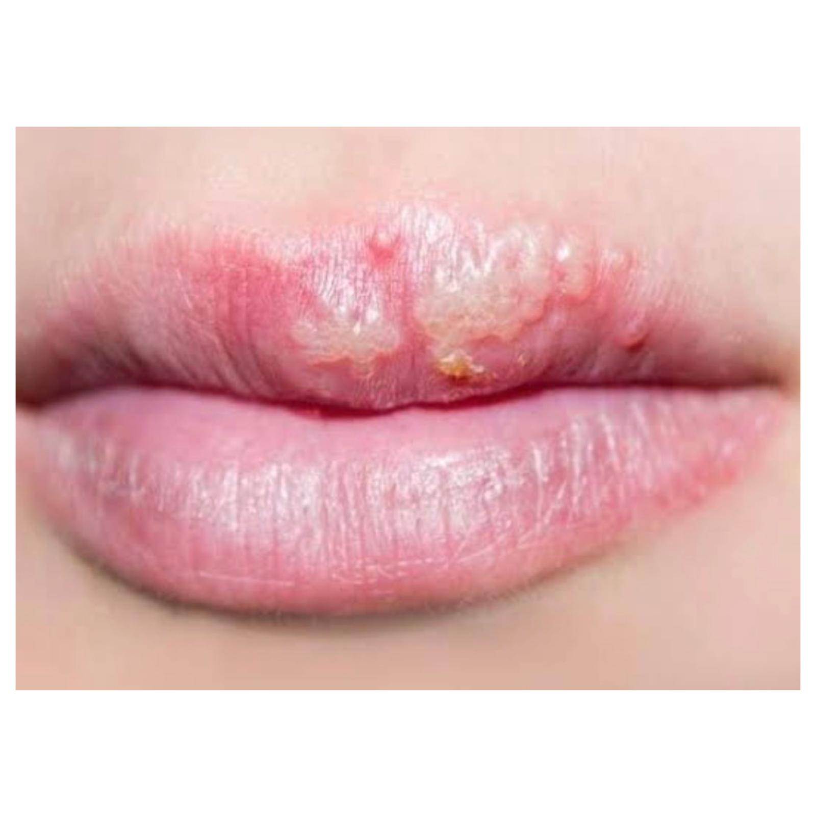Herpes Orofacial