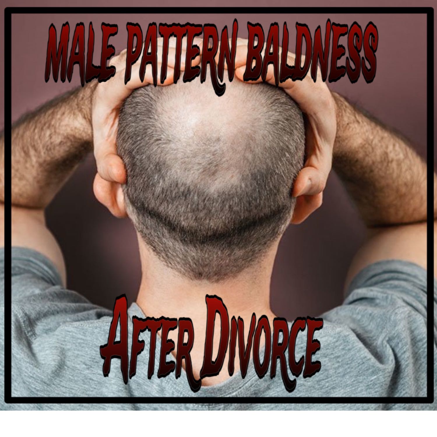 Male Pattern Baldness After Divorce