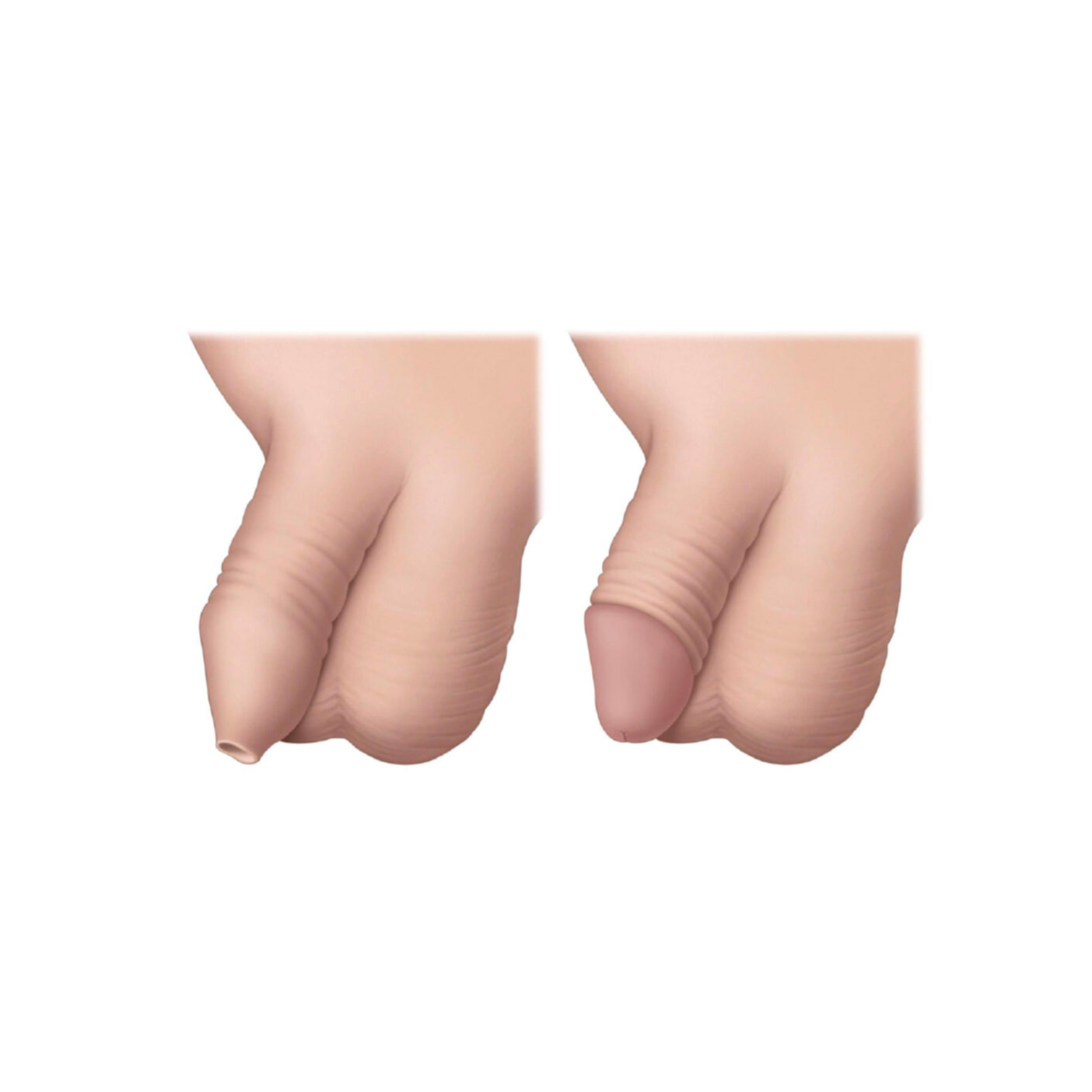 ختنه | Circumcision