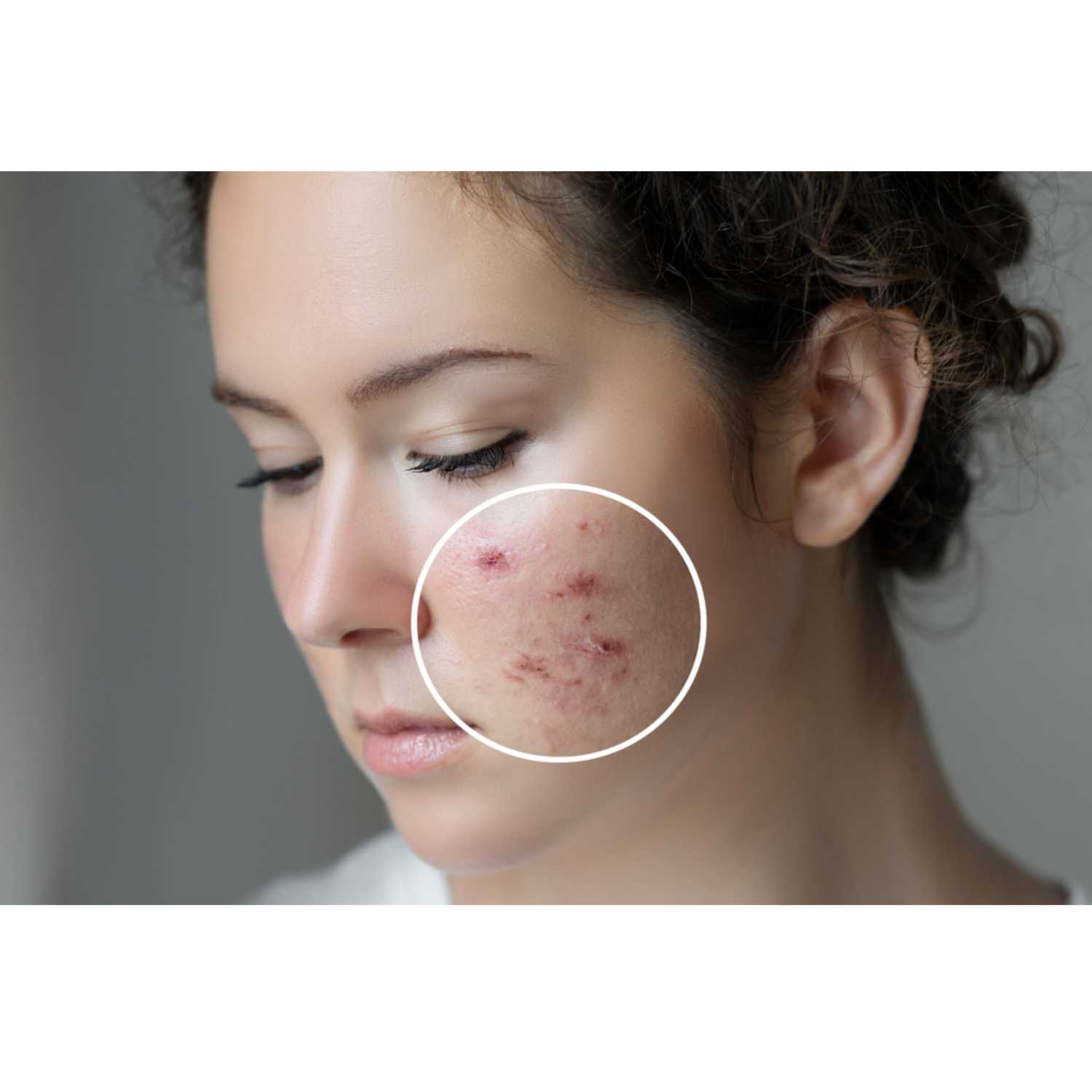 How to best treat acne scars episode artwork