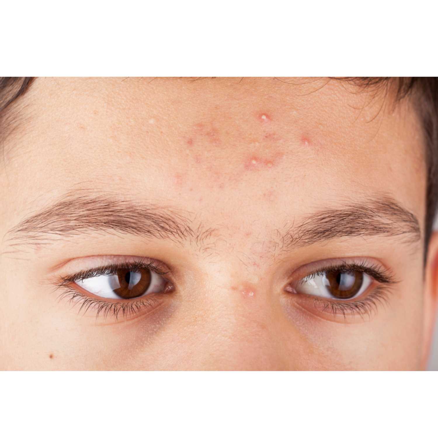 What causes forehead acne? episode artwork