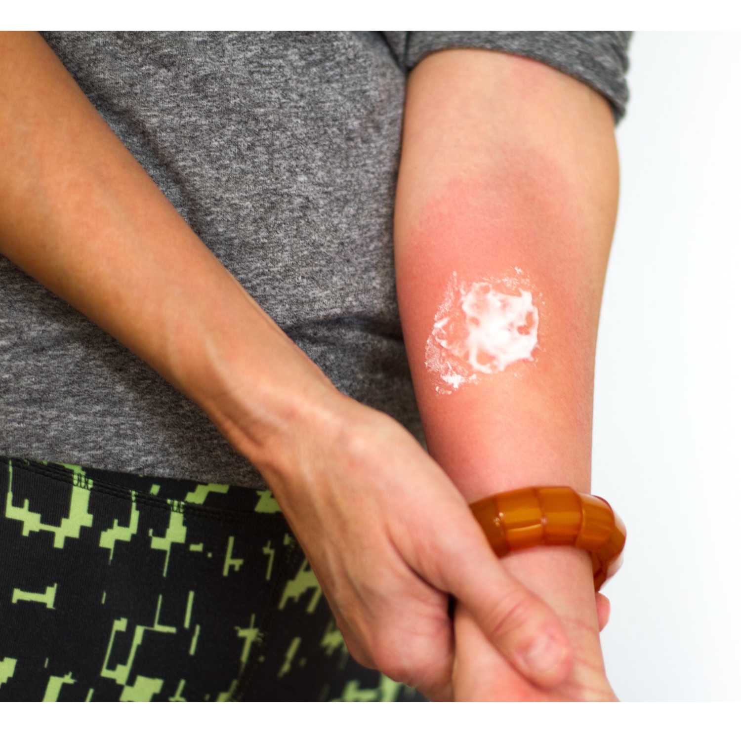 How to identify and get rid of an amoxicillin rash? episode artwork