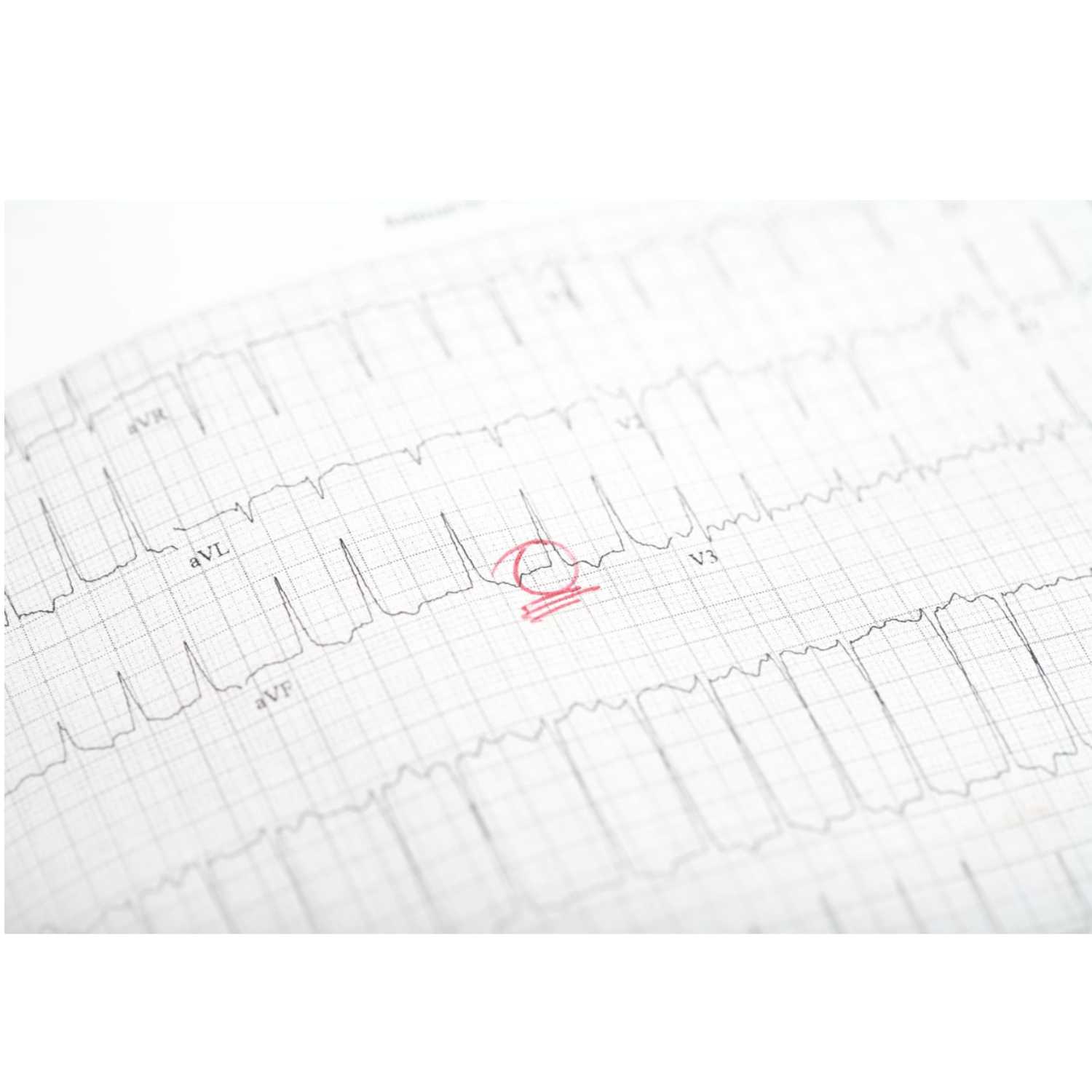 Untreated AFib may raise the risk of cognitive decline episode artwork