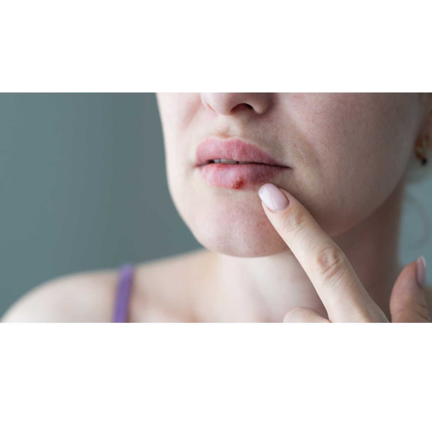Is there a quick way to remove a cold sore episode artwork