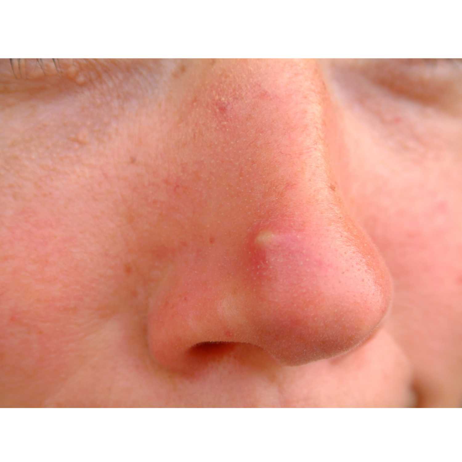 What causes a pimple in the nose episode artwork