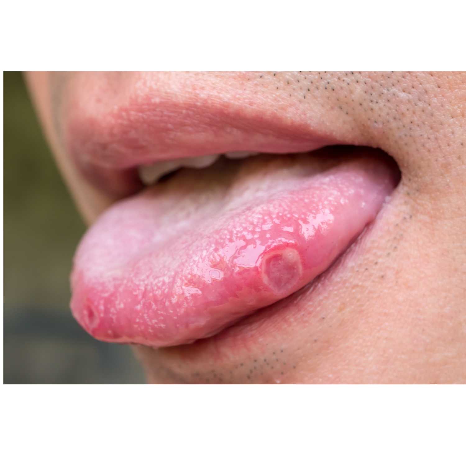 Herpes On Tongue episode artwork