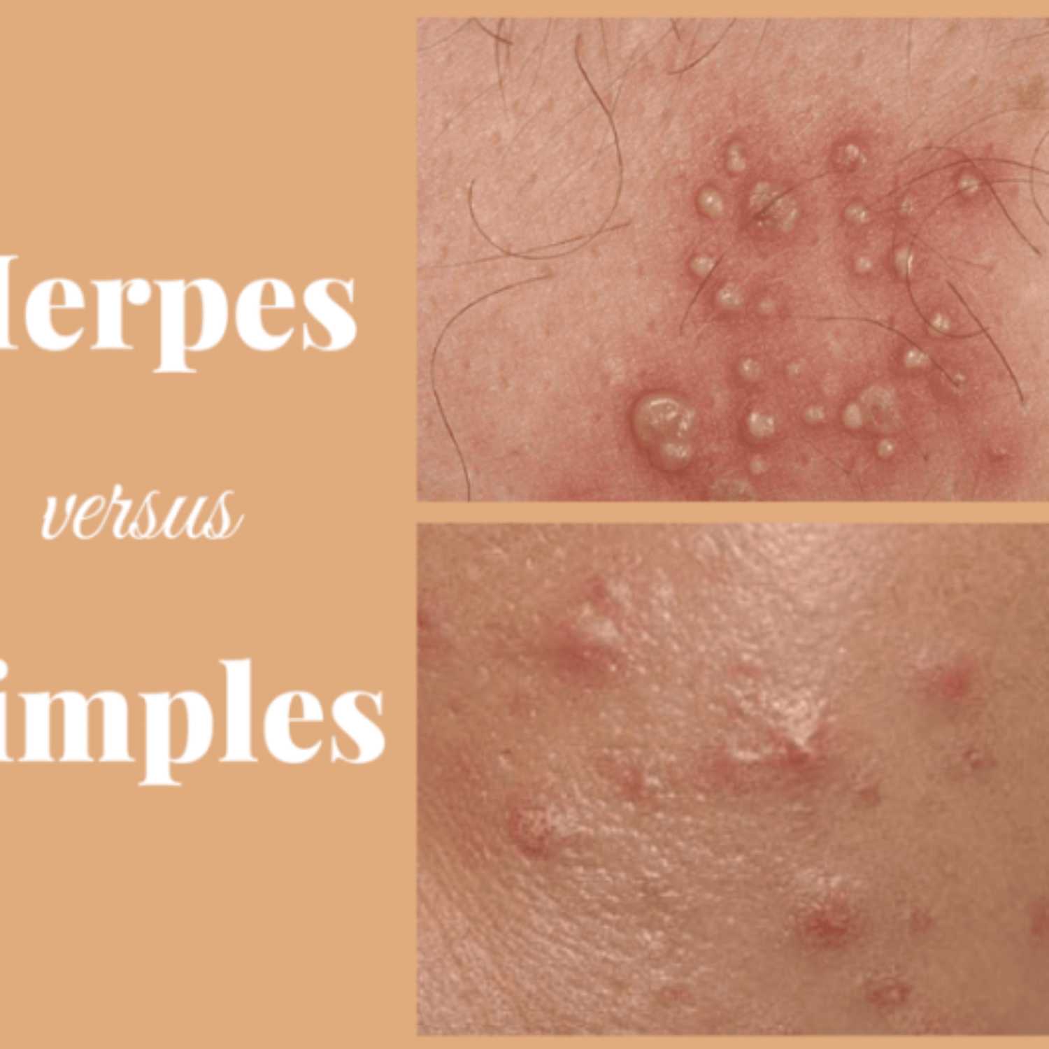 The Difference Between Herpes vs. Pimple episode artwork