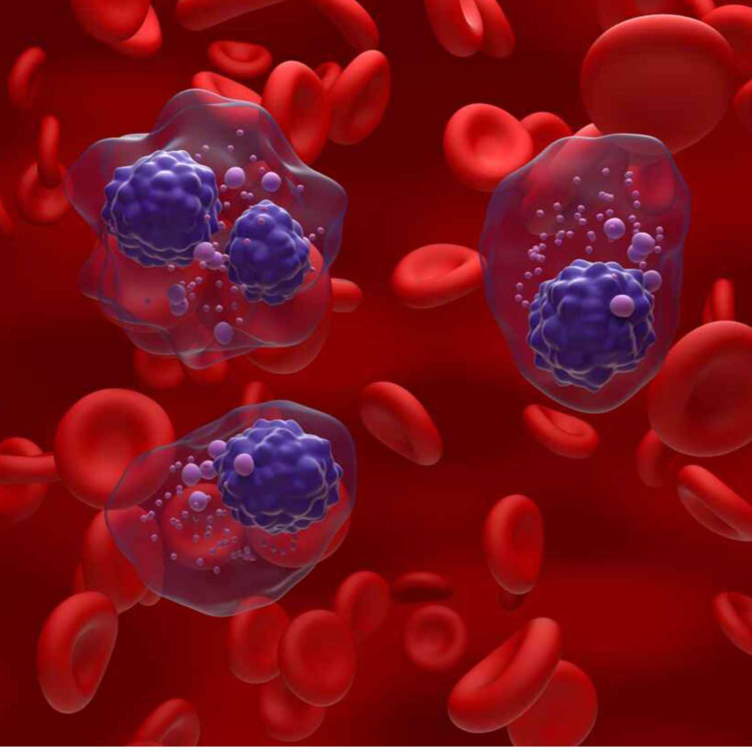 Obesity Linked To Precursor To Multiple Myeloma Blood Cancer episode artwork