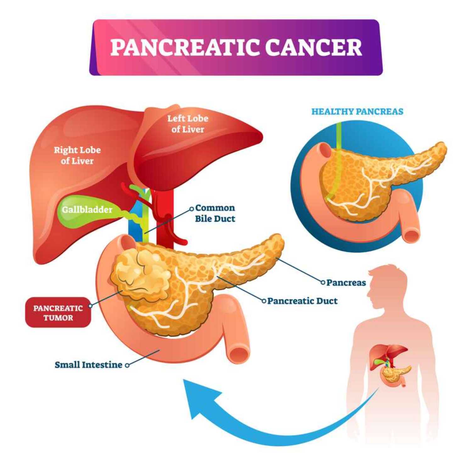 Ozempic, Wegovy, Other Glp-1ra Drugs Not Linked To Increased Pancreatic Cancer Risk, Study Finds episode artwork