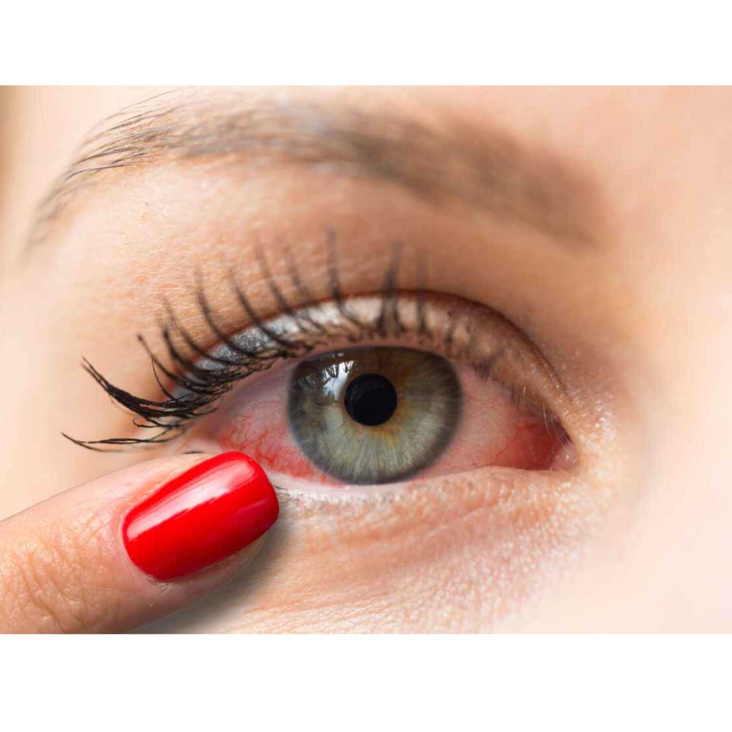 What Is Infective Conjunctivitis Or Pinkeye episode artwork