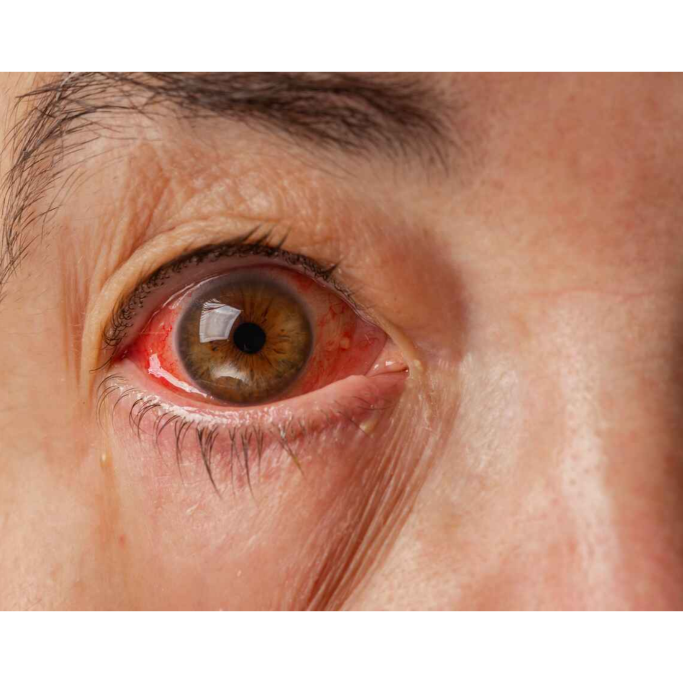 Pink Eye Explained: Understanding the Causes and Symptoms of Conjunctivitis episode artwork