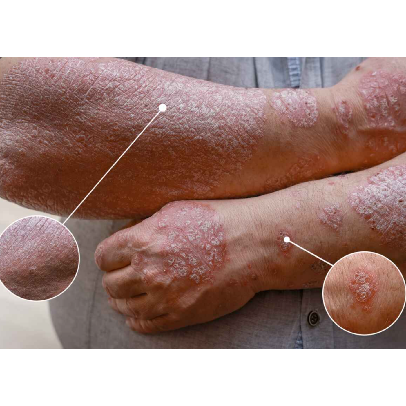 Is Psoriasis Genetic episode artwork