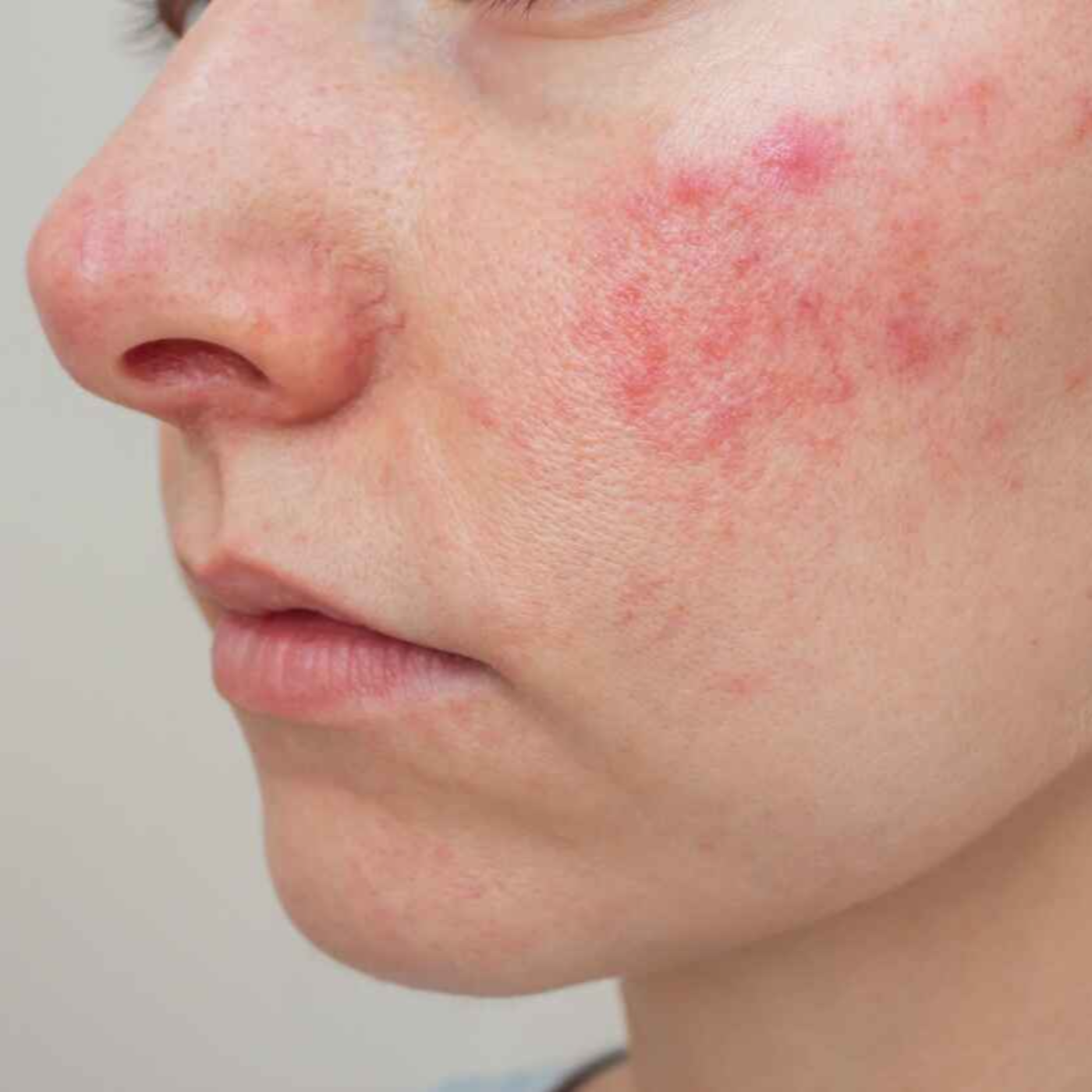 Is Rosacea Contagious episode artwork