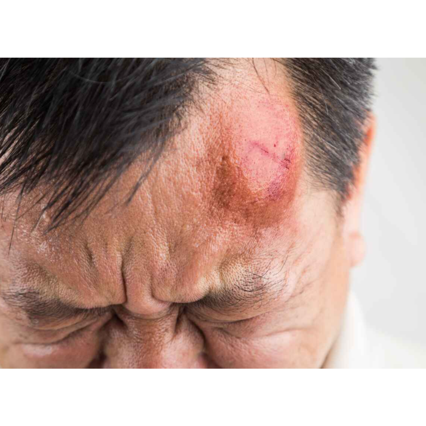 Why Does the Lump on My Head Hurt When I Press It episode artwork