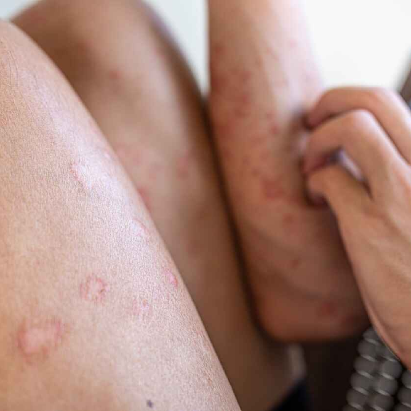 Managing Chronic Inflammation With Psoriasis episode artwork