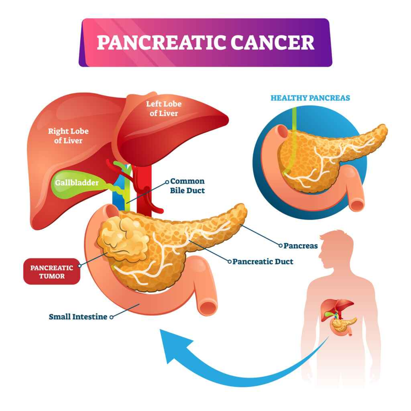 Ozempic, Wegovy, Other Glp-1ra Drugs Not Linked To Increased Pancreatic Cancer Risk, Study Finds episode artwork