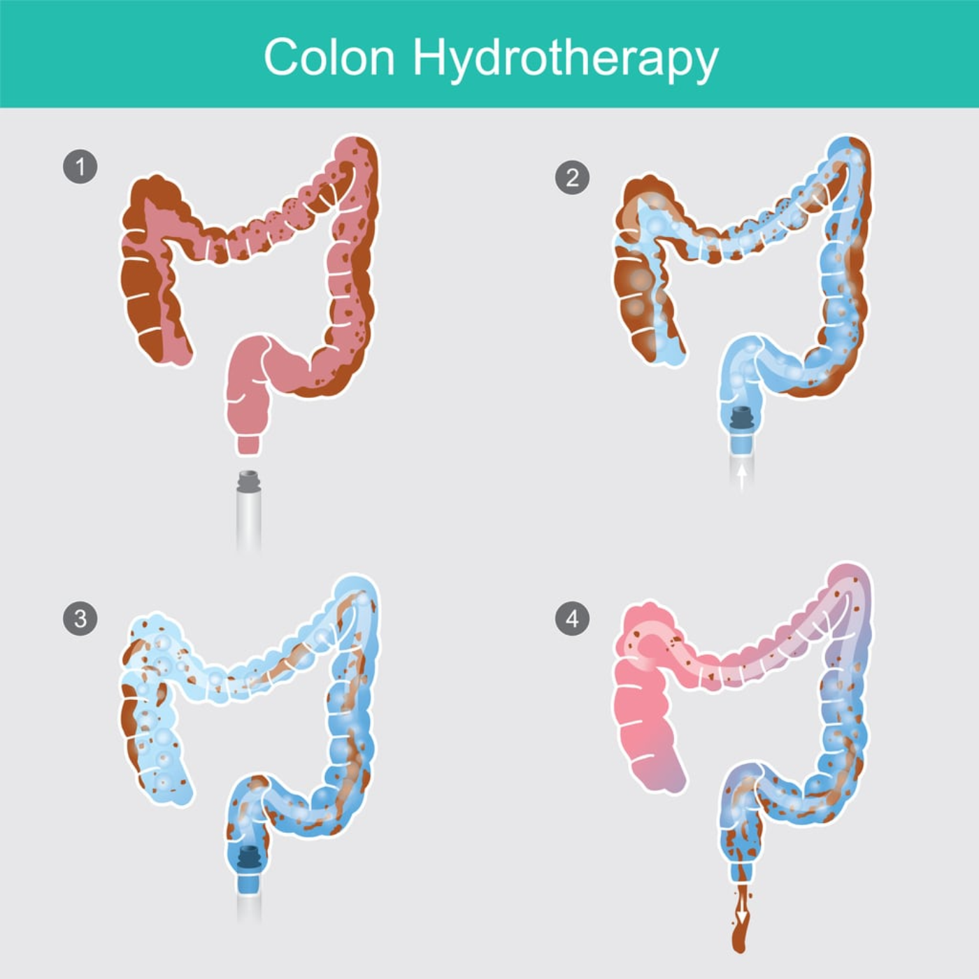 What To Know About Mucoid Plaque episode artwork