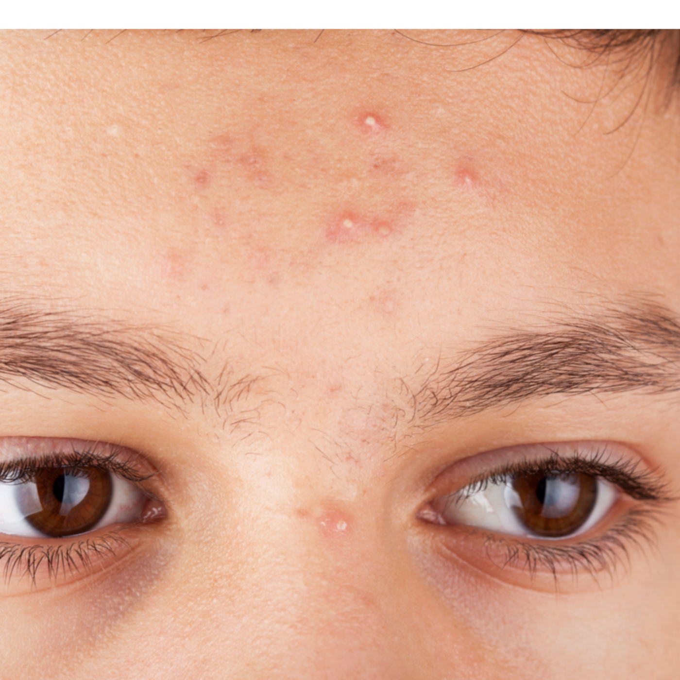 What Causes Forehead Acne? episode artwork