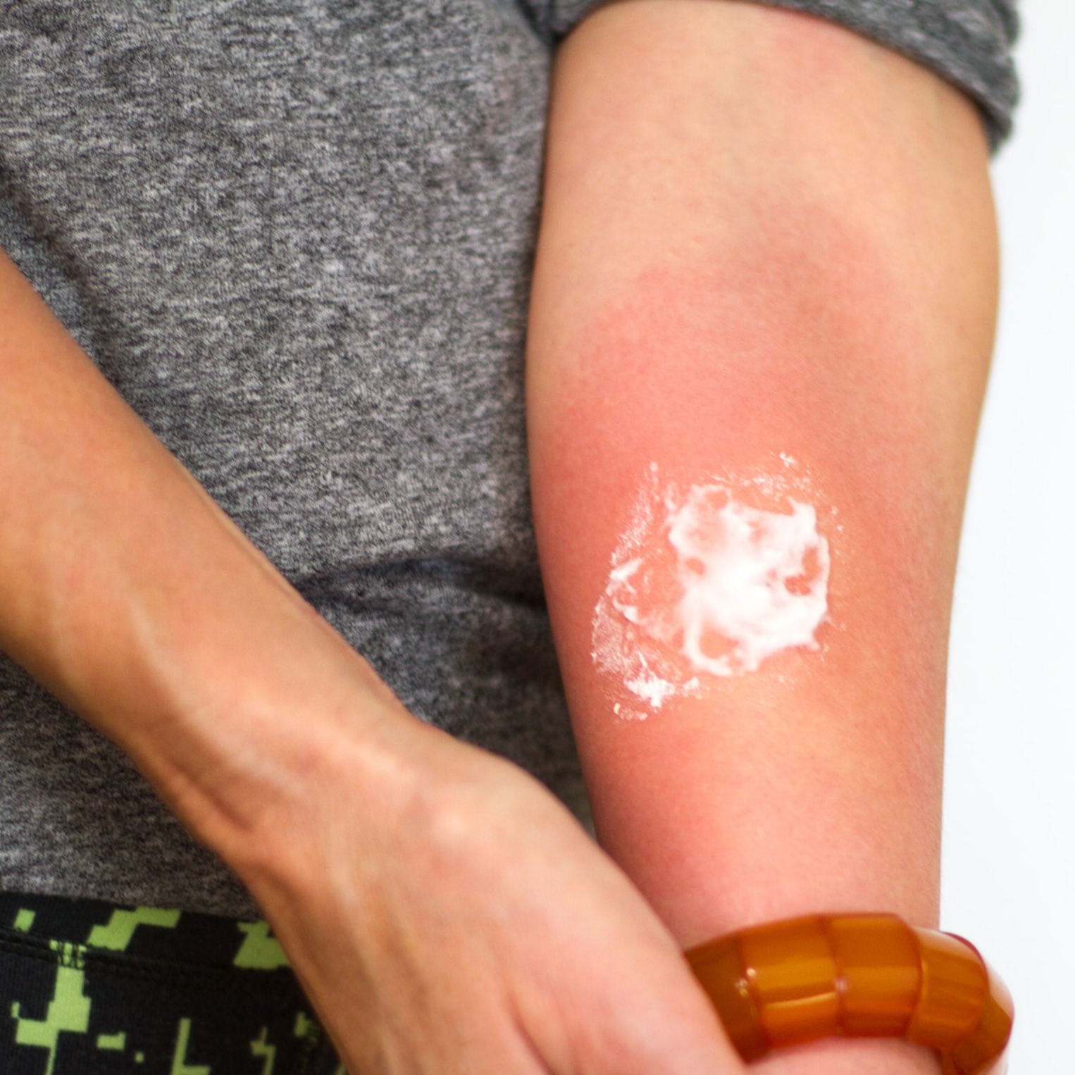 How To Identify And Get Rid Of An Amoxicillin Rash, image size:1526x1526