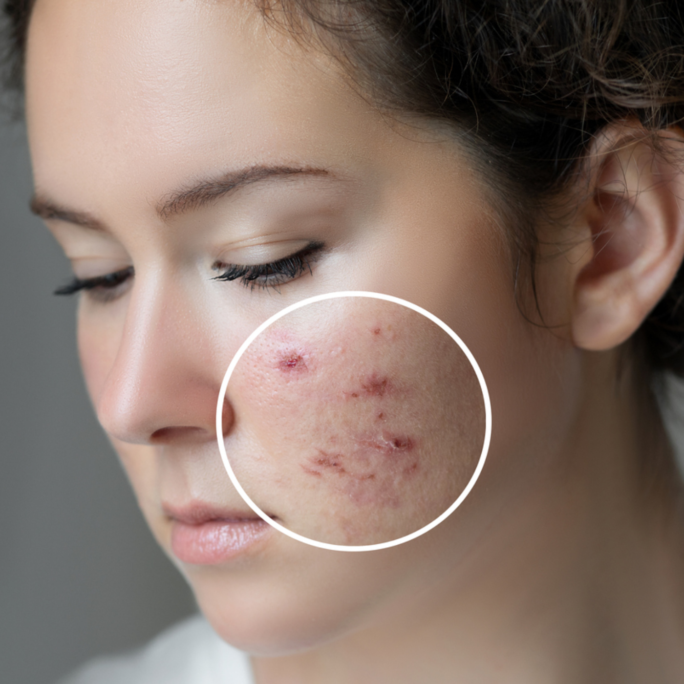 How To Best Treat Acne Scars episode artwork