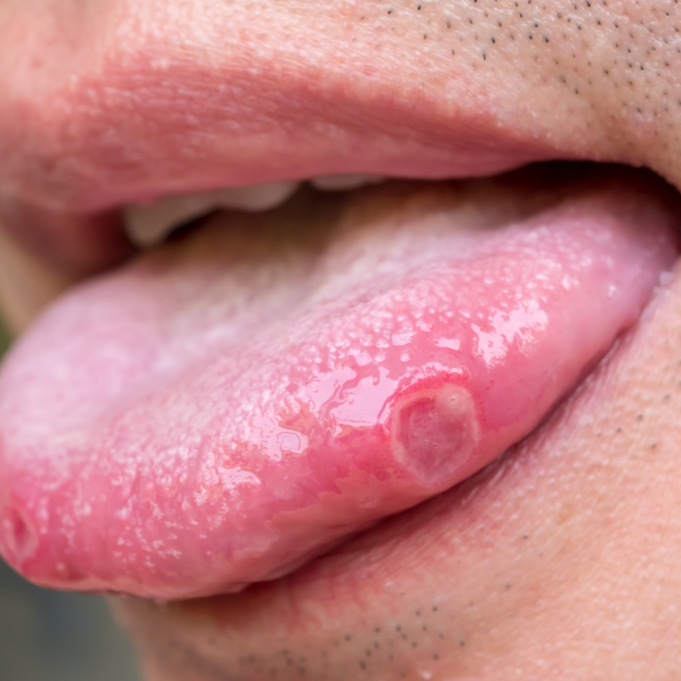 Herpes on the Tongue Symptoms Causes and Treatment, image size:1400x1400