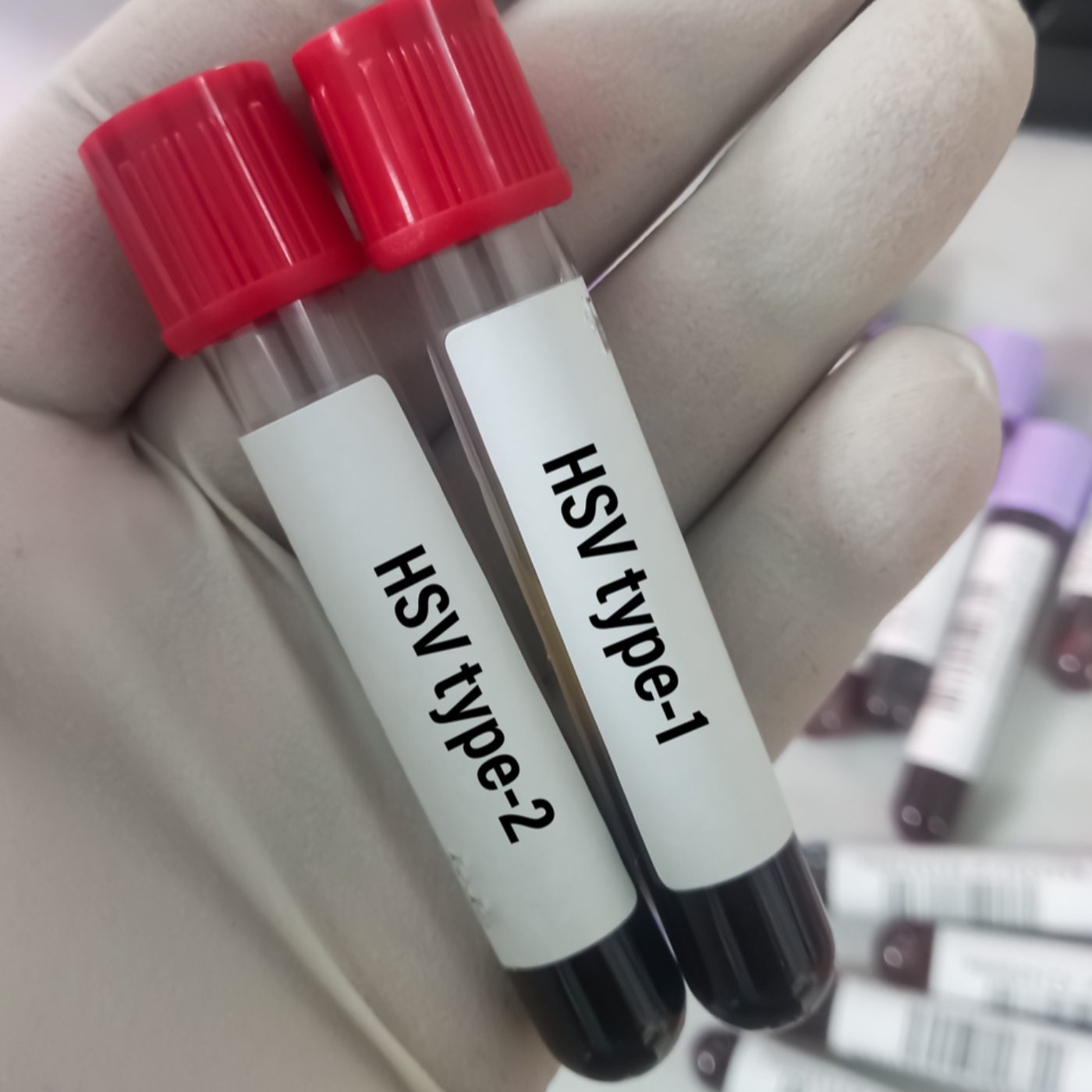 How Many People Have HSV-1 And HSV-2? episode artwork