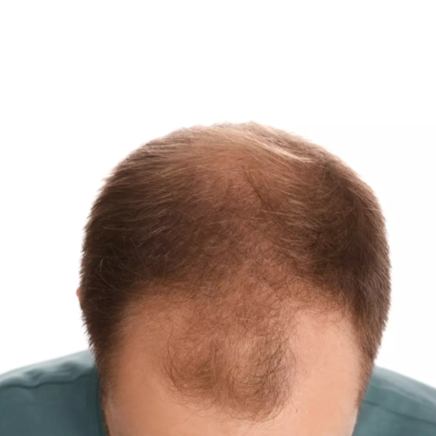 PRP Therapy for Hair Loss in 2025: A Natural Alternative to Finasteride episode artwork