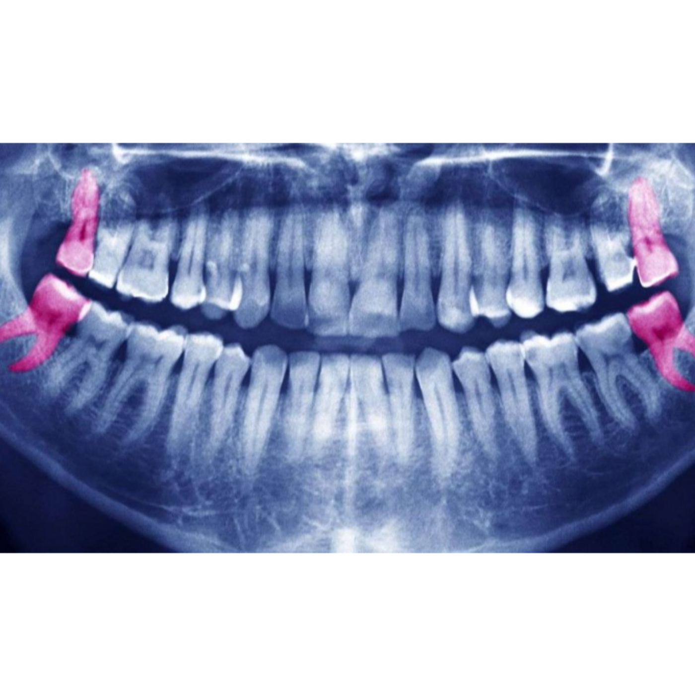 Wisdom Teeth 101: What to Expect and When to Act episode artwork