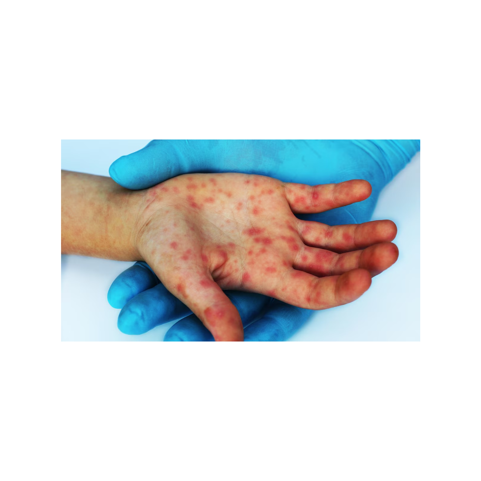 CONFIRMA SESA SIETE CASOS DE COXSACKIE EN ESCUELAS DE TLAXCALA; MENORES ESTÁN ESTABLES Y BAJO OBSERVACIÓN MÉDICA 🦠🏫🧒👩‍⚕️