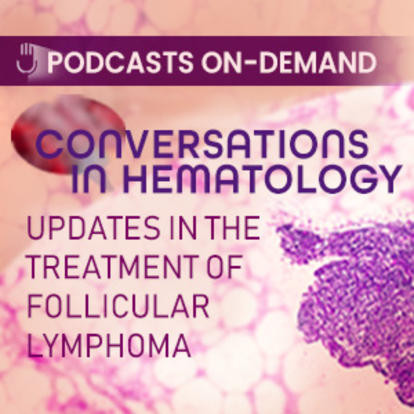 Episode 18 - Conversations in Hematology/Oncology: Incorporating Key Updates in the Treatment of Follicular Lymphoma: A Discussion Following ASH 2023 on Assimilating Practice-Changing Breakthroughs - Part 3 episode artwork
