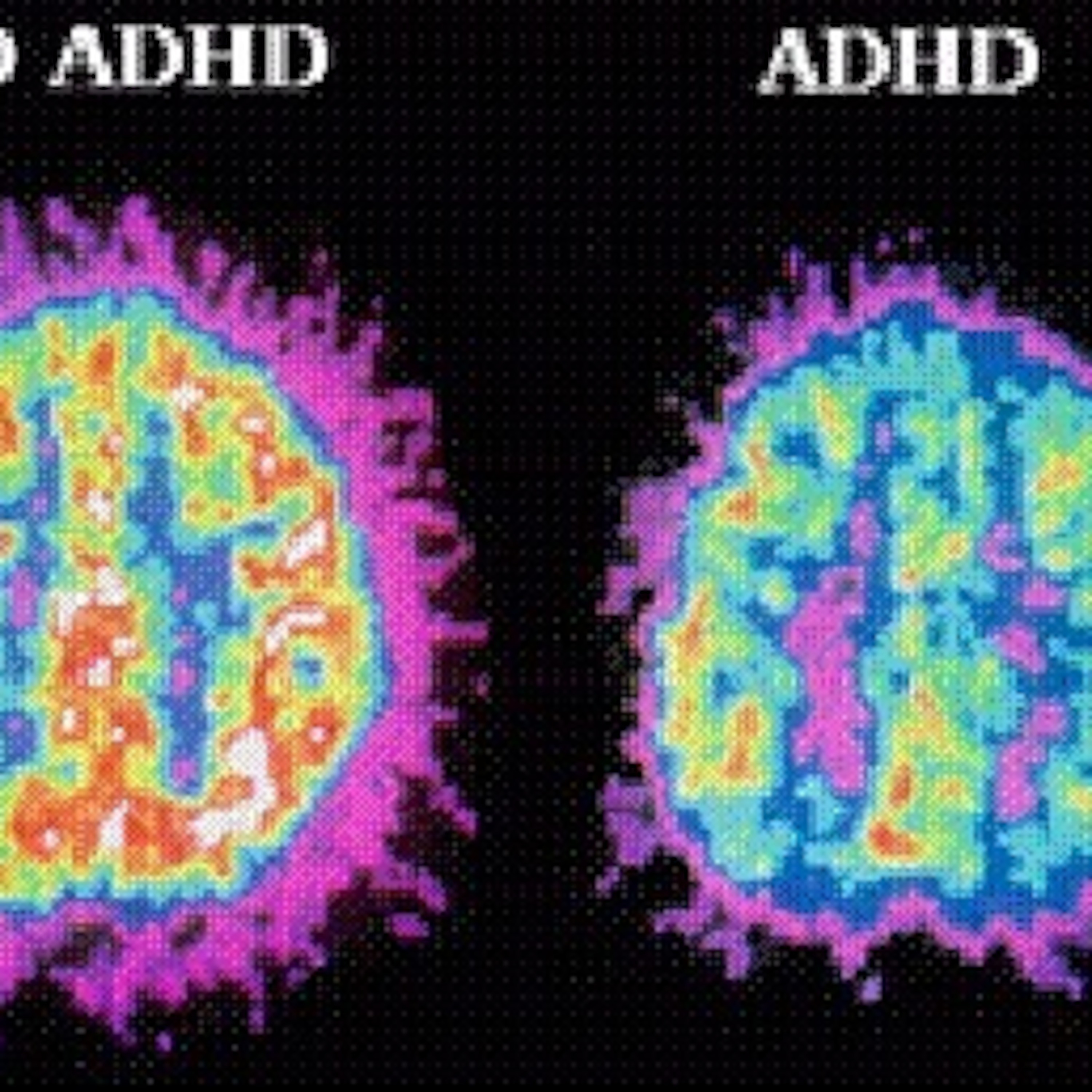 ADHD episode artwork