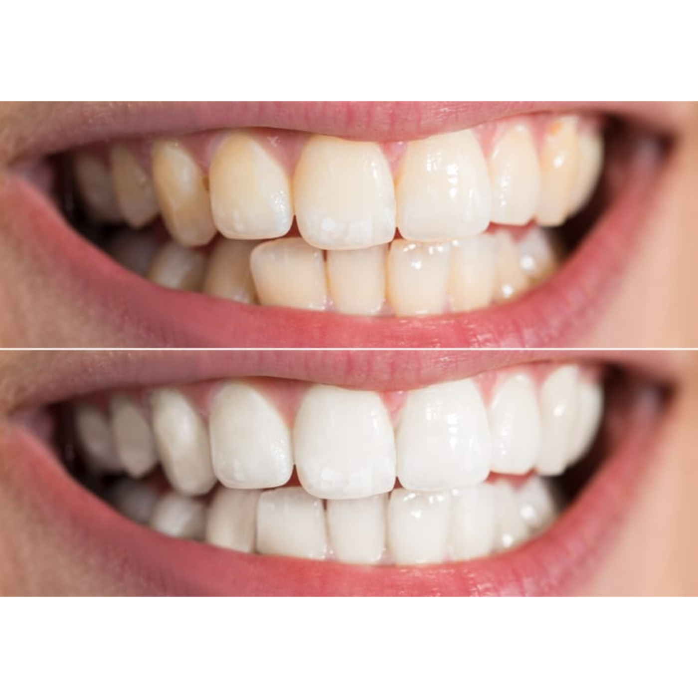 White Spots After Whitening: What You Need to Know episode artwork