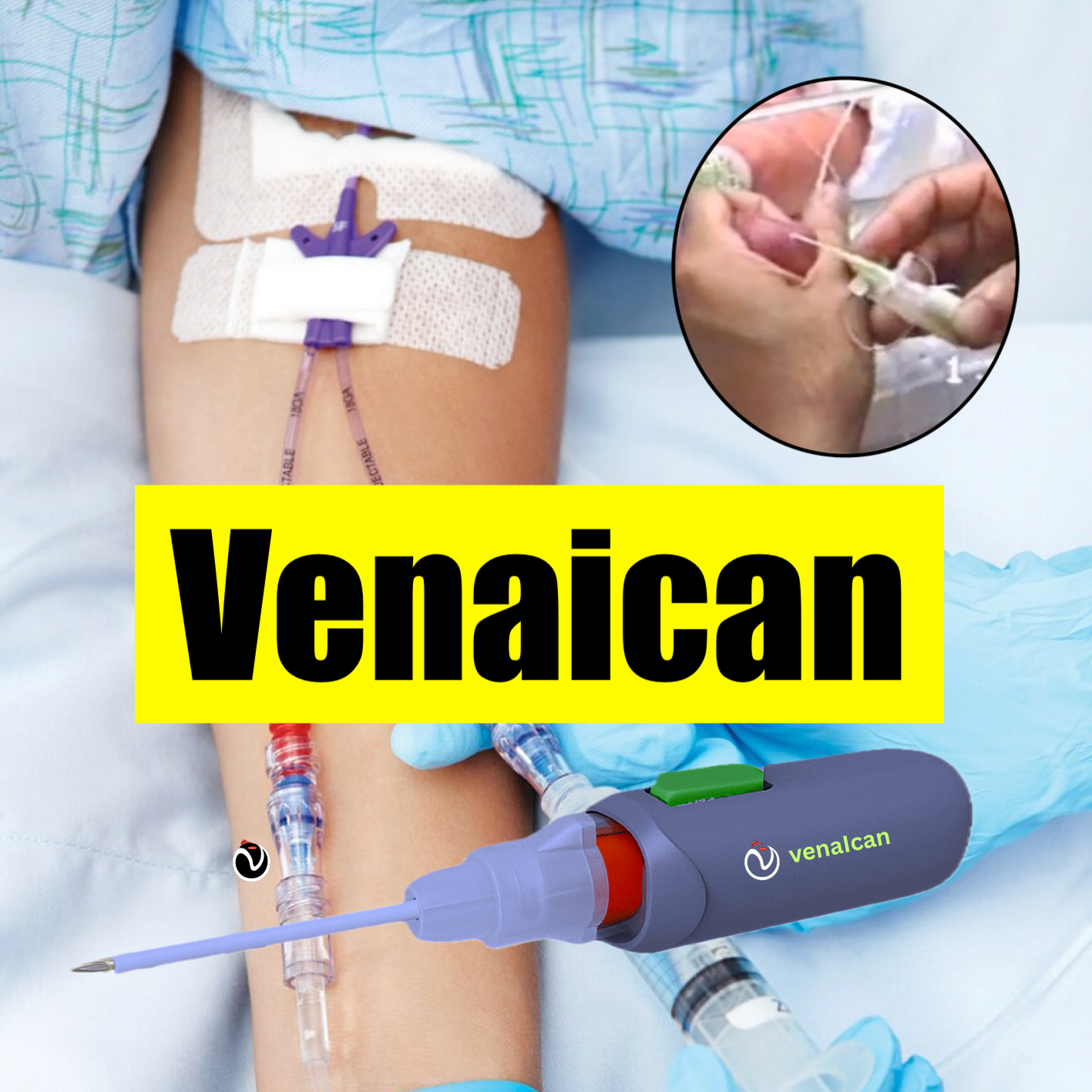 Pain-Free IV Cannula Insertion, Every Time!