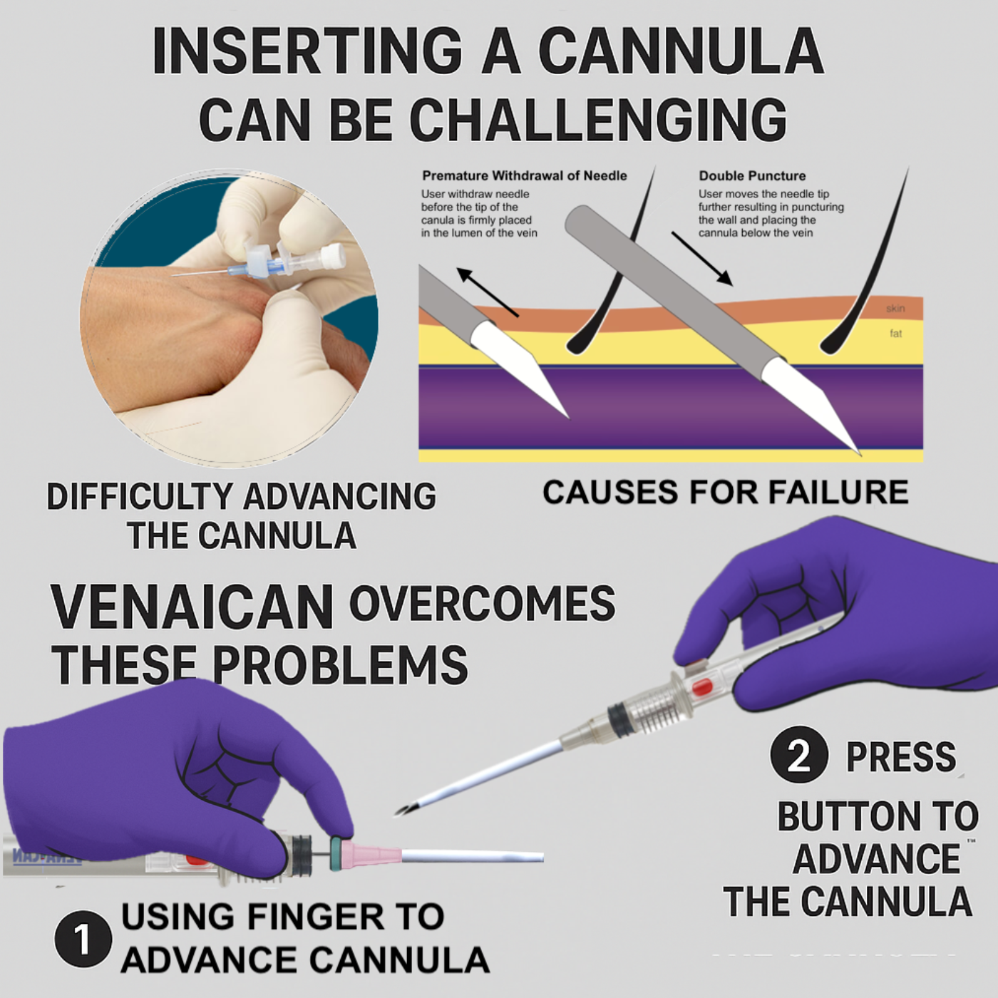 Why IV Cannulation Remains a Daunting Task and How Can We Simplify and Ease the Technique?