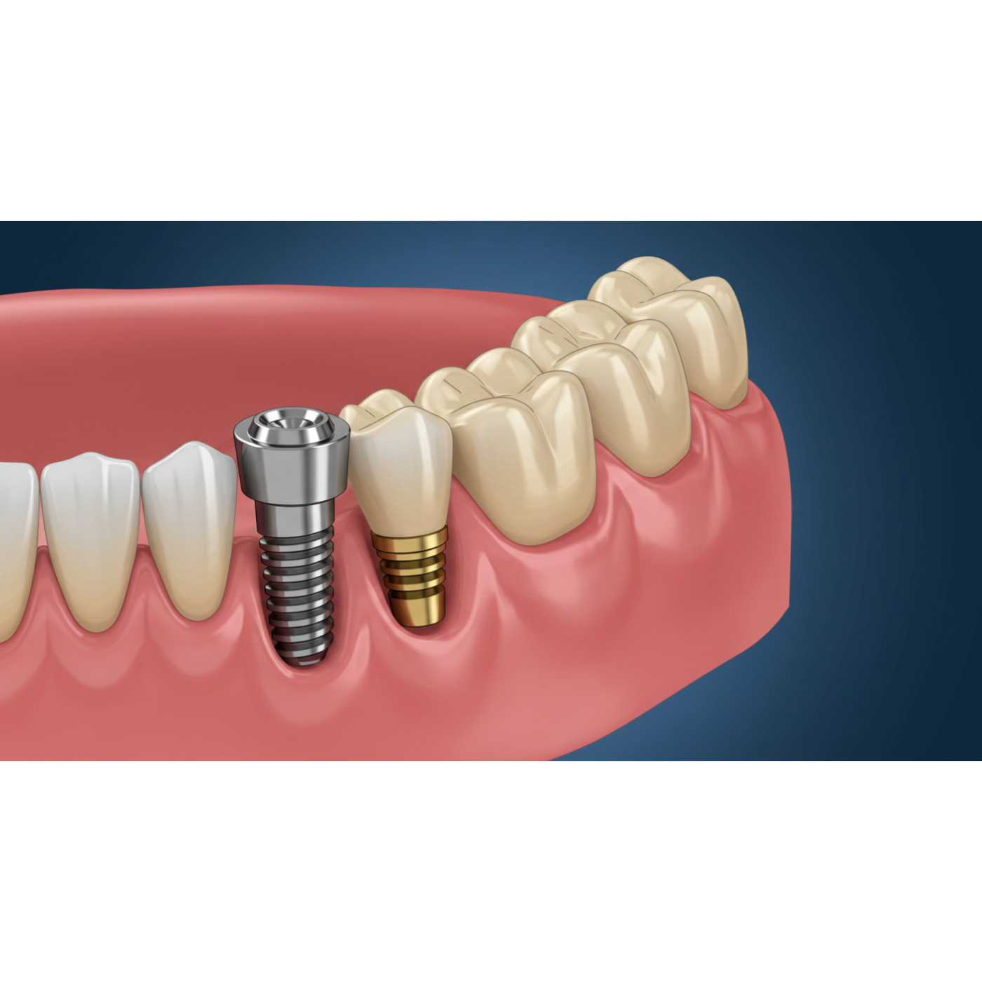 Say Goodbye to Denture Woes: All About Implant-Supported Overdentures episode artwork